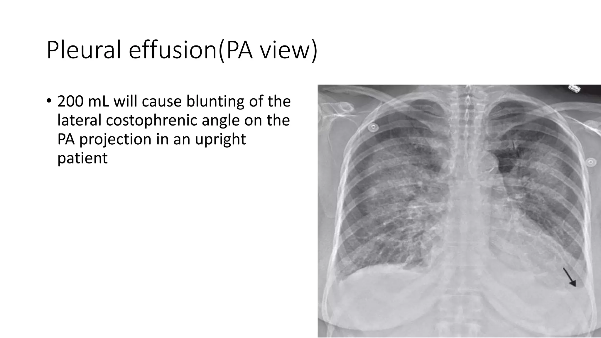 pleural-effusion-x-ray-findings-pdf