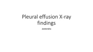 Pleural effusion X-ray
findings
Jeetendra
 