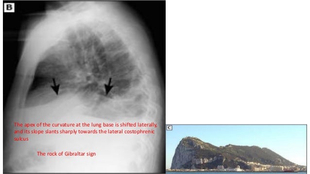 Pleural effusion(X-ray Findings)
