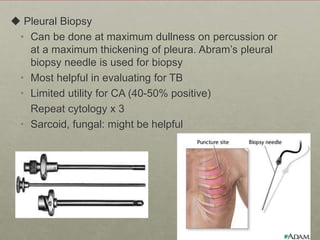  Pleural Biopsy
• Can be done at maximum dullness on percussion or
at a maximum thickening of pleura. Abram’s pleural
biopsy needle is used for biopsy
• Most helpful in evaluating for TB
• Limited utility for CA (40-50% positive)
Repeat cytology x 3
• Sarcoid, fungal: might be helpful
 