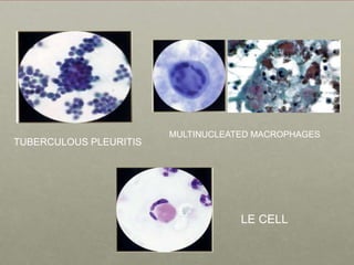LE CELL
TUBERCULOUS PLEURITIS
MULTINUCLEATED MACROPHAGES
 