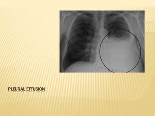 PLEURAL EFFUSION
 