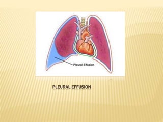PLEURAL EFFUSION
 