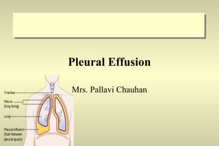 Pleural Effusion
Mrs. Pallavi Chauhan
 
