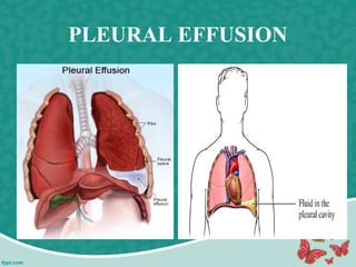 PLEURAL EFFUSION
 