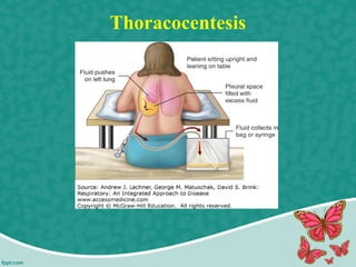 Thoracocentesis
 