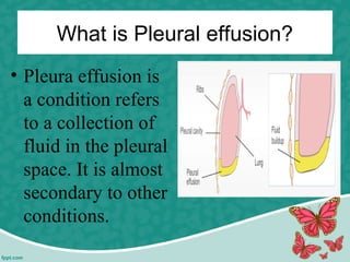 What is Pleural effusion?
• Pleura effusion is
a condition refers
to a collection of
fluid in the pleural
space. It is almost
secondary to other
conditions.
 