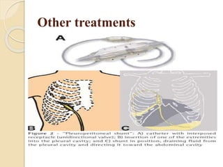 Other treatments
 Surgical pleurectomy
 Insertion of a small catheter attached to a
drainage bottle for outpatient management
 Implantation of a Pleura peritoneal shunt
 