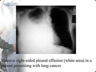 Massive right-sided pleural effusion (white area) in a
patient presenting with lung cancer
 