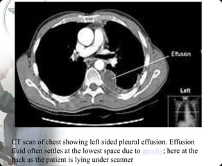 CT scan of chest showing left sided pleural effusion. Effusion
fluid often settles at the lowest space due to gravity; here at the
back as the patient is lying under scanner
 