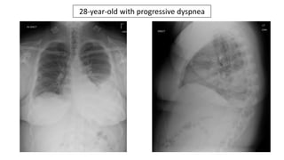 28-year-old with progressive dyspnea
 