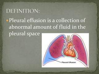 Pleural effusion is a collection of
abnormal amount of fluid in the
pleural space
 