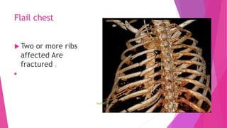 Flail Rips PLEURAL EFFUSION.pptx