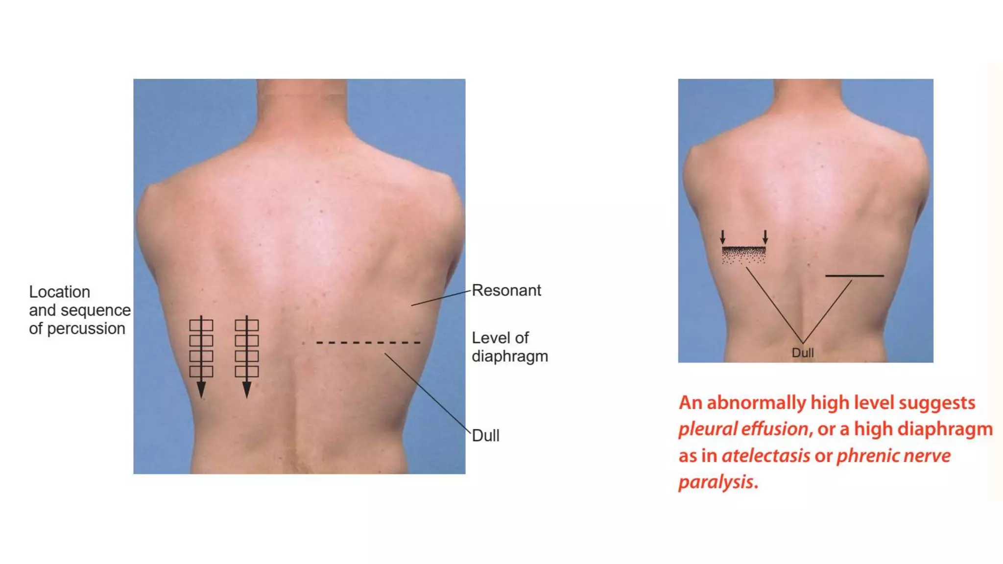 Diagramatic Excursion Diaphragmatic excursion pleural effusion photos - Supernova ...