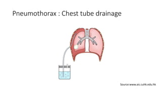 Pneumothorax : Chest tube drainage
Source:www.aic.cuhk.edu.hk
 