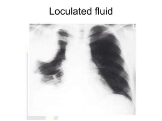 Pleural effusion (dr. mahesh) | PPTX