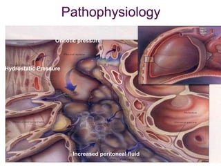 Pathophysiology
Hydrostatic Pressure
Oncotic pressure
Increased peritoneal fluid
 