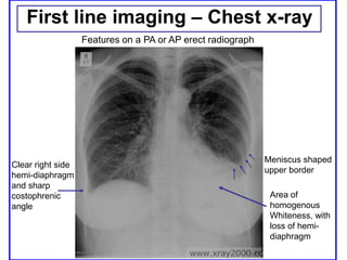 First line imaging – Chest x-ray
Clear right side
hemi-diaphragm
and sharp
costophrenic
angle
Area of
homogenous
Whiteness, with
loss of hemi-
diaphragm
Meniscus shaped
upper border
Features on a PA or AP erect radiograph
 