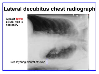 Lateral decubitus chest radiograph
Free layering pleural effusion
At least 100ml
pleural fluid is
necessary
 