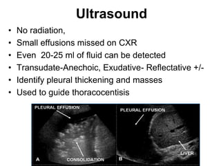 Ultrasound
• No radiation,
• Small effusions missed on CXR
• Even 20-25 ml of fluid can be detected
• Transudate-Anechoic, Exudative- Reflectative +/-
• Identify pleural thickening and masses
• Used to guide thoracocentisis
 
