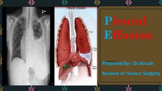 Pleural
Effusion
Prepared by : Dr.Anush
Resident of Thoracic Surgery
 