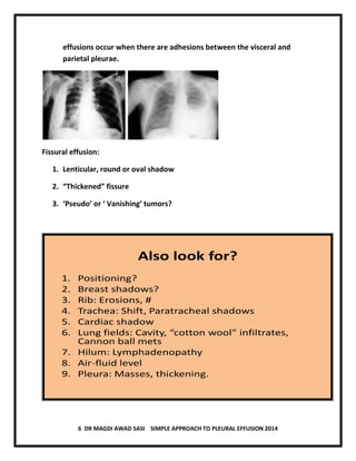 6 DR MAGDI AWAD SASI SIMPLE APPROACH TO PLEURAL EFFUSION 2014
effusions occur when there are adhesions between the visceral and
parietal pleurae.
Fissural effusion:
1. Lenticular, round or oval shadow
2. “Thickened” fissure
3. ‘Pseudo’ or ‘ Vanishing’ tumors?
Also look for?
1. Positioning?
2. Breast shadows?
3. Rib: Erosions, #
4. Trachea: Shift, Paratracheal shadows
5. Cardiac shadow
6. Lung fields: Cavity, “cotton wool” infiltrates,
Cannon ball mets
7. Hilum: Lymphadenopathy
8. Air-fluid level
9. Pleura: Masses, thickening.
 