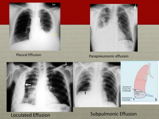 Pleural Effusion for Undergraduates | PPTX