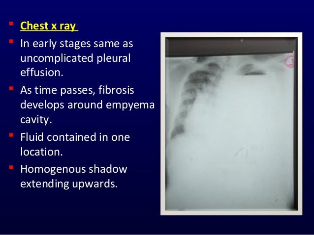 Pleural empyema dr.tinku joseph