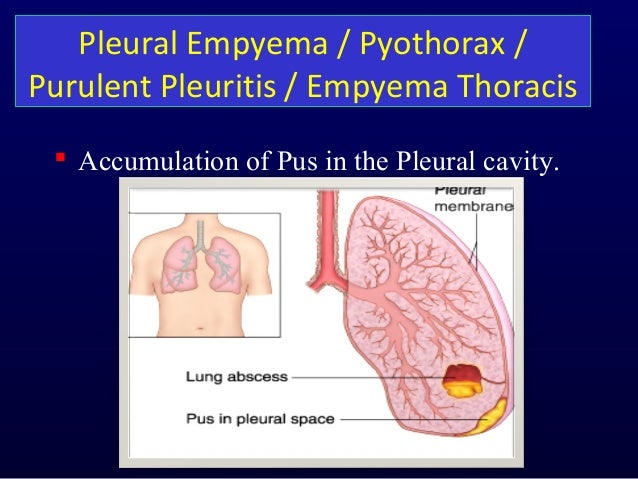 empyema