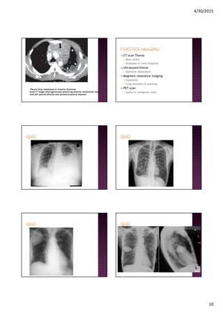 4/30/2015
10
Pleural drop metastases in invasive thymoma:
Axial CT image heterogeneously enhancing anterior mediastinal mass
mild left pleural effusion and ipsilateral pleural implants
CT scan Thorax
Most useful
Available at most hospitals
Ultrasound thorax
Operator dependent
Magnetic resonance imaging
Expensive
Long duration of scanning
PET scan
Useful in malignant cases
 