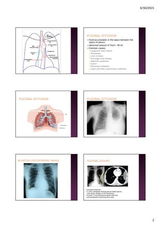 4/30/2015
2
fluid accumulates in the space between the
layers of pleura
abnormal amount of fluid > 50 ml
Common causes:
Congestive heart failure
Pneumonia
Liver cirrhosis
End-stage renal disease
Nephrotic syndrome
Cancer
Pulmonary embolism
Lupus and other autoimmune conditions
Loculated empyema:
A: Chest radiograph showing pleural-based opacity
with obtuse margins in left hemithorax
B: Axial CT scan showing loculated collection
with peripherally enhancing thick walls
 