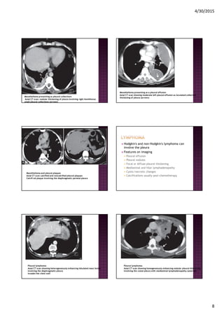 4/30/2015
8
Mesothelioma presenting as pleural collections
Axial CT scan: nodular thickening of pleura involving right hemithorax
small pleural collections (arrows)
Mesothelioma presenting as a pleural effusion
Axial CT scan showing moderate left pleural effusion as loculated collection
thickening of pleura (arrows)
Mesothelioma and pleural plaques
Axial CT scan calcified and noncalcified pleural plaques
Calcifi ed plaque involving the diaphragmatic parietal pleura
Hodgkin's and non-Hodgkin's lymphoma can
involve the pleura
Features on imaging
Pleural effusion
Pleural nodules
Focal or diffuse pleural thickening
Mediastinal and hilar lymphadenopathy
Cystic/necrotic changes
Calcifications usually post-chemotherapy
Pleural lymphoma:
Axial CT scan showing heterogeneously enhancing lobulated mass lesion
involving the diaphragmatic pleura
invades the chest wall
Pleural lymphoma:
Axial CT scan showing homogeneously enhancing nodular pleural thickening
involving the costal pleura with mediastinal lymphadenopathy (asterisk)
 