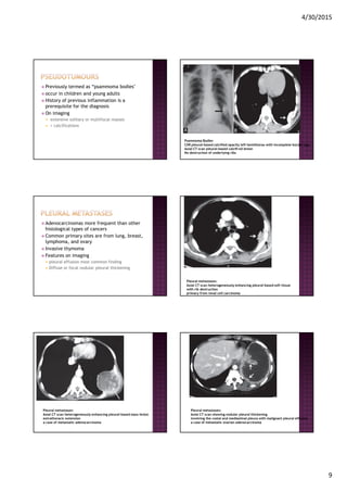 4/30/2015
9
Previously termed as “psammoma bodies"
occur in children and young adults
History of previous inflammation is a
prerequisite for the diagnosis
On imaging
extensive solitary or multifocal masses
+ calcifications
Psammoma Bodies
CXR pleural-based calcified opacity left hemithorax with incomplete border sign
Axial CT scan pleural-based calcifi ed lesion
No destruction of underlying ribs
Adenocarcinomas more frequent than other
histological types of cancers
Common primary sites are from lung, breast,
lymphoma, and ovary
Invasive thymoma
Features on imaging
pleural effusion most common finding
Diffuse or focal nodular pleural thickening
Pleural metastases:
Axial CT scan heterogeneously enhancing pleural-based soft tissue
with rib destruction
primary from renal cell carcinoma
Pleural metastases:
Axial CT scan heterogeneously enhancing pleural-based mass lesion
extrathoracic extension
a case of metastatic adenocarcinoma
Pleural metastases:
Axial CT scan showing nodular pleural thickening
involving the costal and mediastinal pleura with malignant pleural effusion
a case of metastatic ovarian adenocarcinoma
 