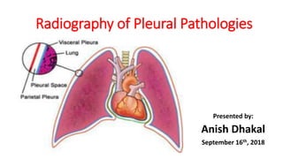 Radiography of Pleural Pathologies
Presented by:
Anish Dhakal
September 16th, 2018
 