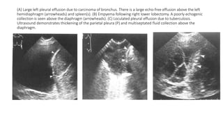 Approach in Pleural pathologies by Dr. Subash Pathak | PPTX
