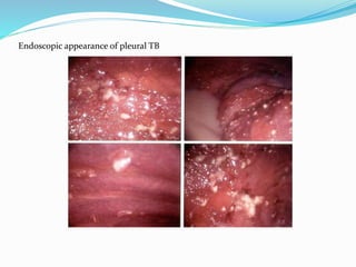 Endoscopic appearance of pleural TB
 