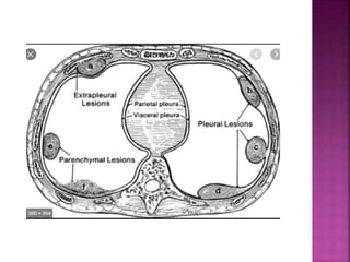 Imaging of Pleural tumors Dr Alekya | PPTX