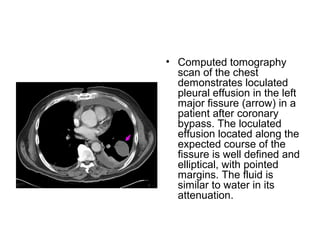 Pleural diseases chest radiology part1 | PPT
