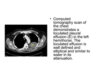 Pleural diseases chest radiology part1 | PPT