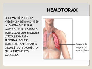 EL HEMOTÓRAX ES LA
PRESENCIA DE SANGRE EN
LA CAVIDAD PLEURAL,
CAUSADO POR LESIONES
TORÁCICAS QUE PRODUCE
DIFICULTAD PARA
RESPIRAR, DOLOR
TORÁCICO, ANSIEDAD O
INQUIETUD, Y AUMENTO
EN LA FRECUENCIA
CARDIACA.
 