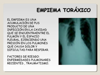 EL EMPIEMA ES UNA
ACUMULACIÓN DE PUS
PRODUCTO DE UNA
INFECCIÓN EN LA CAVIDAD
QUE SE ENCUENTRAENTRE EL
PULMÓN Y EL ESPACIO
PLEURAL, EJERCIENDO UNA
PRESIÓN EN LOS PULMONES
QUE CAUSA DOLOR Y
DIFICULTAD PARA RESPIRAR.
FACTORES DE RIESGO:
ENFERMEDADES PULMONARES
RECIENTES , TRAUMATISMO.
 