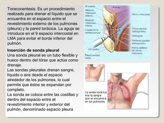 Toracocentesis: Es un procedimiento
realizado para drenar el líquido que se
encuentra en el espacio entre el
revestimiento externo de los pulmones
(pleura) y la pared torácica. La aguja se
introduce en el 9 espacio intercostal en
LMA para evitar el borde inferior del
pulmón.
Inserción de sonda pleural
Una sonda pleural es un tubo flexible y
hueco dentro del tórax que actúa como
drenaje.
Las sondas pleurales drenan sangre,
líquido o aire desde el espacio
alrededor de los pulmones, lo cual
permite que éstos se expandan por
completo.
La sonda se coloca entre las costillas y
dentro del espacio entre el
revestimiento interior y exterior del
pulmón, denominado espacio pleura
 