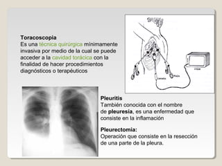 Toracoscopia
Es una técnica quirúrgica mínimamente
invasiva por medio de la cual se puede
acceder a la cavidad torácica con la
finalidad de hacer procedimientos
diagnósticos o terapéuticos
Pleuritis
También conocida con el nombre
de pleuresía, es una enfermedad que
consiste en la inflamación
Pleurectomía:
Operación que consiste en la resección
de una parte de la pleura.
 