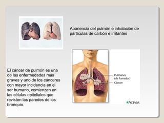 Apariencia del pulmón e inhalación de
partículas de carbón e irritantes
El cáncer de pulmón es una
de las enfermedades más
graves y uno de los cánceres
con mayor incidencia en el
ser humano, comienzan en
las células epiteliales que
revisten las paredes de los
bronquio.
 