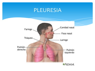 PLEURESIA
 