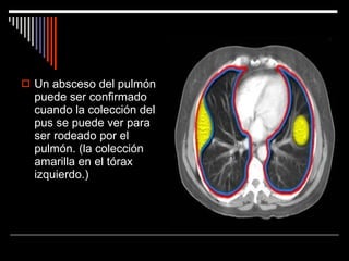 Un absceso del pulmón puede ser confirmado cuando la colección del pus se puede ver para ser rodeado por el pulmón. (la colección amarilla en el tórax izquierdo.)  