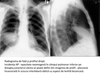 Radiograma de faţă şi profilul drept.
Incidenţa AP - opacitate neomogenă în câmpul pulmonar inferior pe
dreapta,caracterul căreia se poate defini din imaginea de profil - pleurezie
încarcerată în scizura interlobară oblică cu aspect de lentilă biconcavă.
 