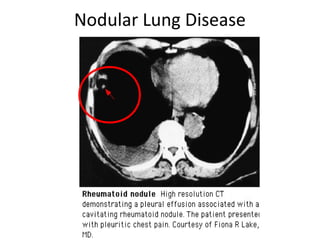 Nodular Lung Disease
 