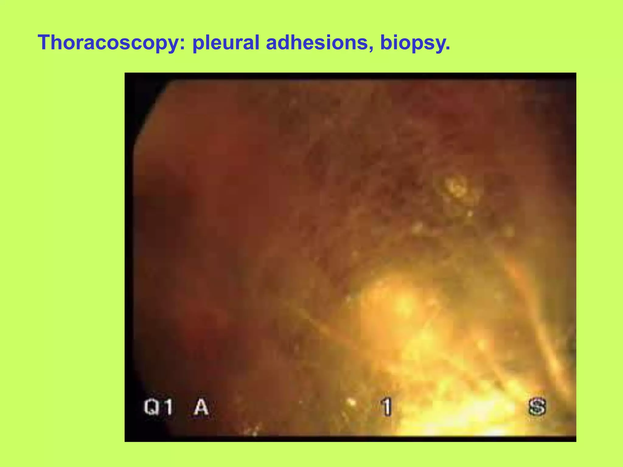 Thoracoscopy: pleural adhesions, biopsy.
 