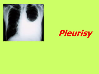 Pleurisy
 